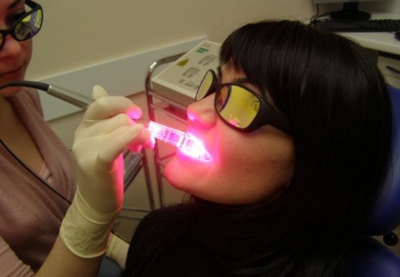 Безопасное отбеливание зубов лазером