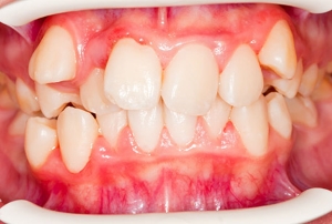 Дистопия зубов