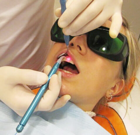 Имплантация зубов при помощи лазера