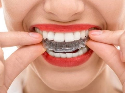 Каппы для отбеливания зубов