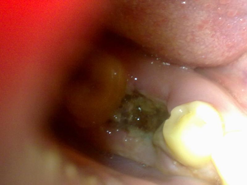 Инфицированная лунка после удаления зуба мудрости