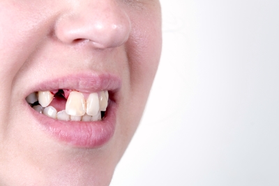 Отзывы о удалении зуба