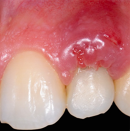 Воспаление после имплантации зубов