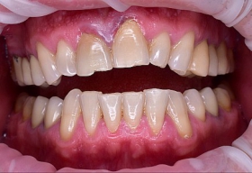Дефект зубов верхней челюсти