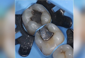 Восстановление эстетической формы зубы