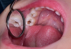 Восстановление потемневшего зуба