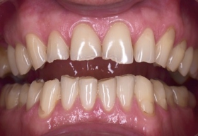 патологическая стираемость зубов