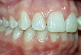 неровность передних зубов на верхней челюсти