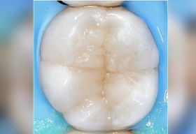 Эстетическая форма зуба восстановлена