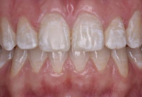 неровность передних зубов на верхней челюсти