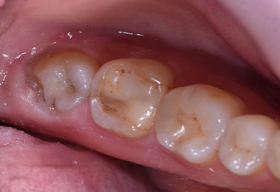 Глубокая продольная трещина 7-го зуба