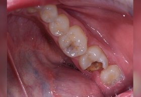 Сильно разрушенный 7-ой зуб на нижней челюсти