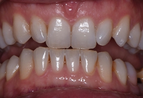Зубы пациента до отбеливания