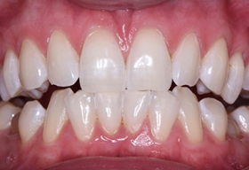После отбеливания зубов системой ZOOM 4
