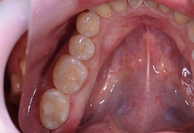 Трансплантация (пересадка) 8-го зуба мудрости на место 7-го зуба