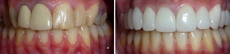 Протезирование передних зубов с использованием безметалловой керамики
