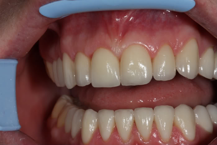 Безметалловые коронки на передние зубы