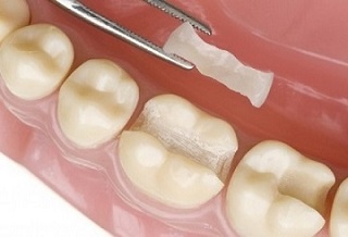 Серебряная или белая пломба: знай, чем тебе лечат зубы