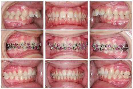 Фото зубов до и после выравнивания
