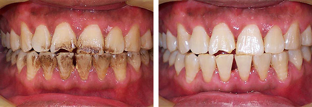 До и после гигиены полости рта