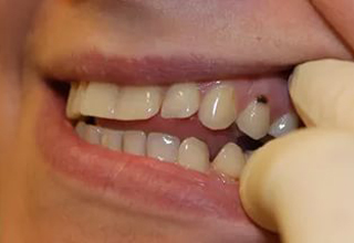 Кариес корня зуба фото
