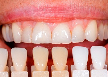 Вкладка на зуб - Стоматология 