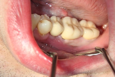 Коронка из диоксида циркония на жевательных зубах