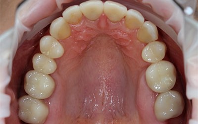 Коронки из диоксида циркония на жевательных зубах