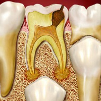 Периодонтит молочных зубов