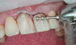 Препарирование зуба под винир