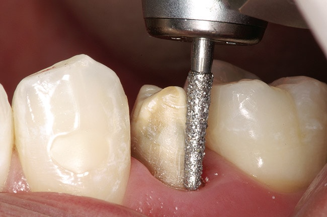 Препарирование зубов под коронку