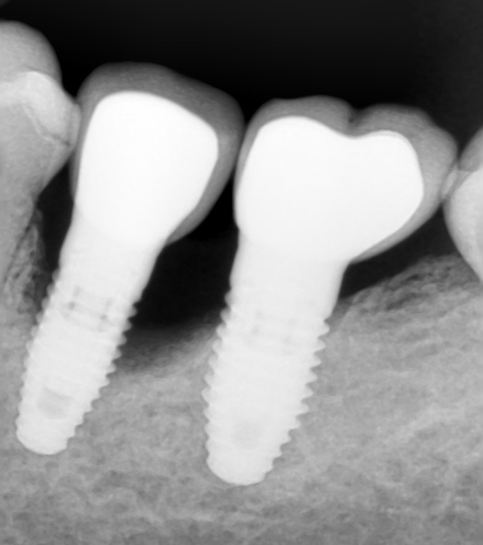 Рентген  импланта зуба
