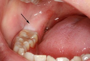 Сухая лунка после удаления зуба — симптомы и лечение