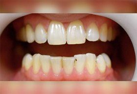 Зубы пациента до отбеливания 