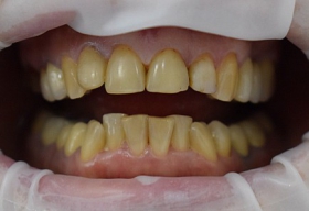 Эстетический дефект центральных зубов