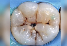 Кариес зуба
