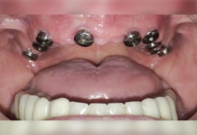 Полное восстановление зубов верхней и нижней челюсти