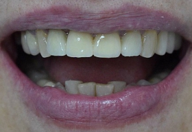 Реставрация четырёх центральных зубов с помощью коронок из оксида циркония.