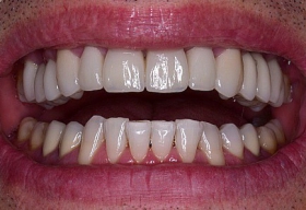 Комплексное восстановление зубов верхней челюсти при помощи керамики на основе оксида циркония и  отбеливание зубов нижней челюсти системой Zoom 3. 