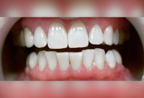Результат после отбеливания зубов в нашей клинике