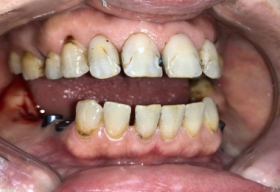 Необходимо сложное лечение зубов, создание условий для удобного жевания и эстетические восстановление улыбки