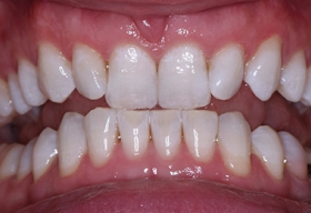 После отбеливания зубов системой ZOOM 4